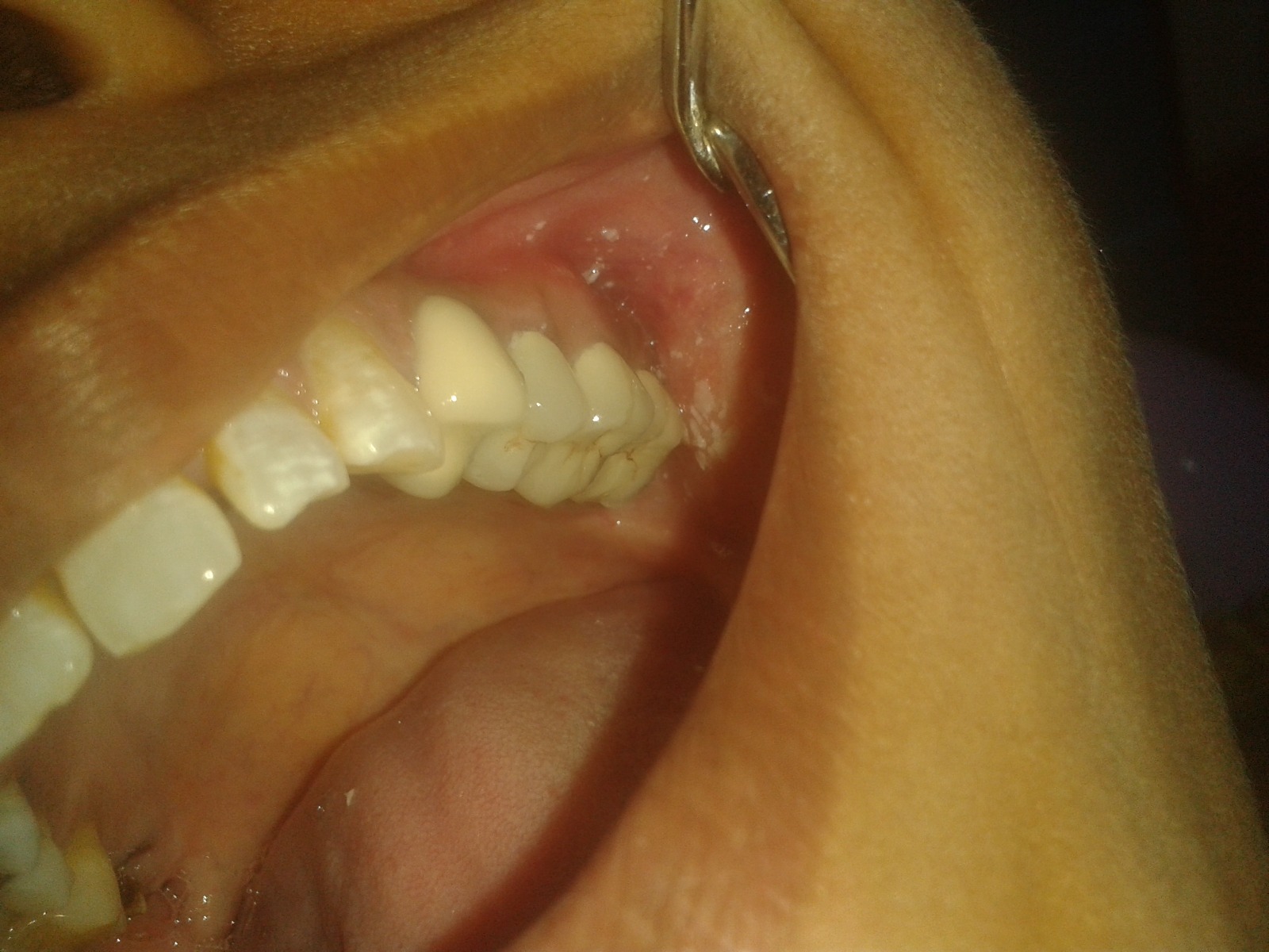 veneers