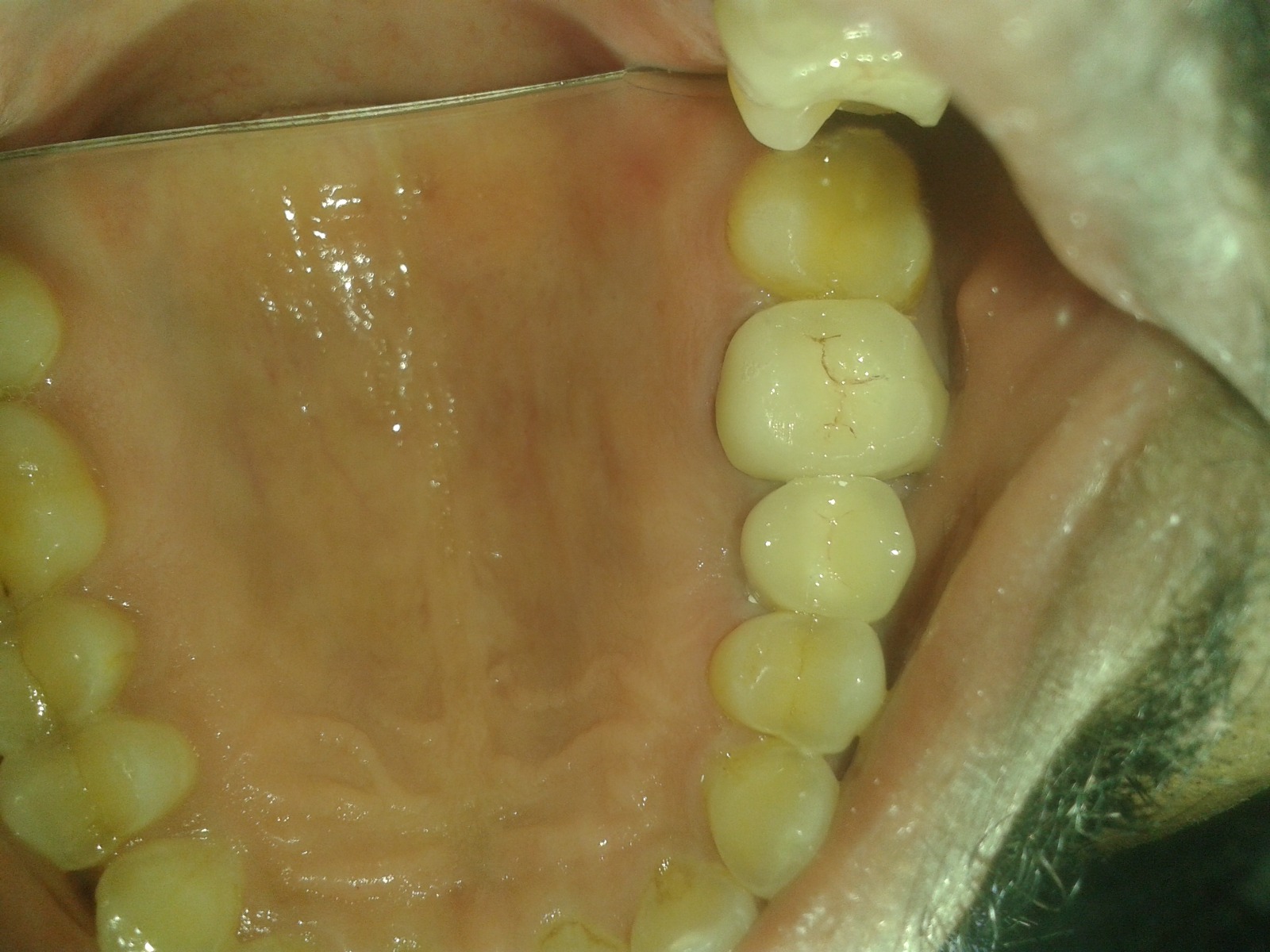 implants