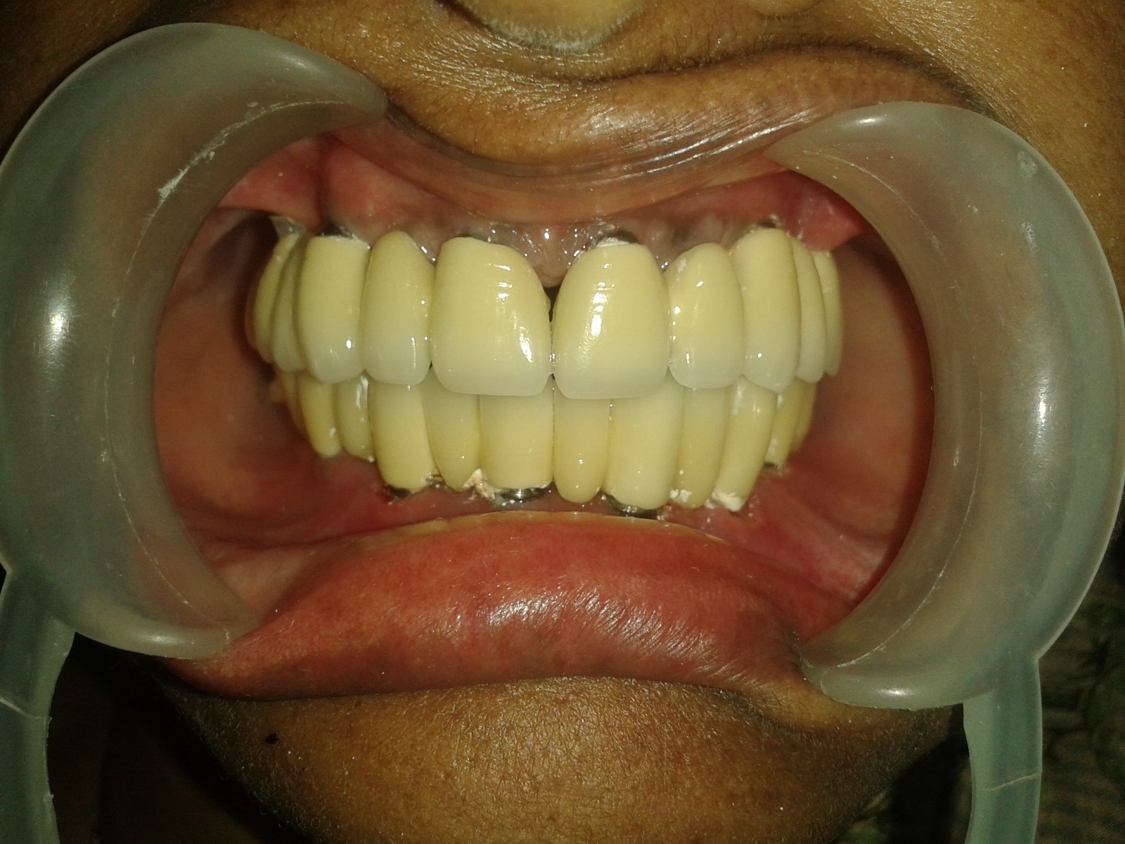 implants