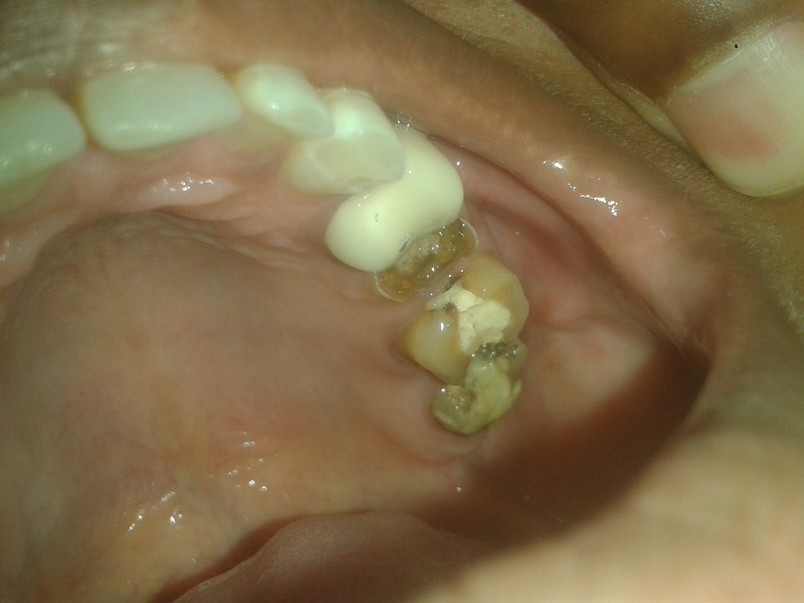 veneers