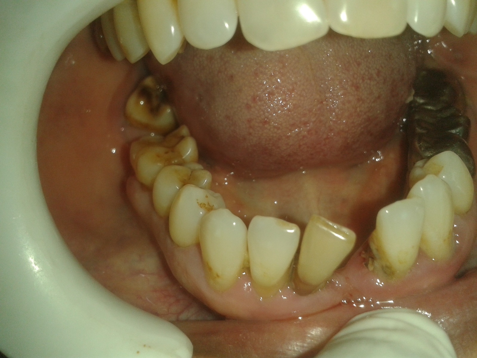 veneers