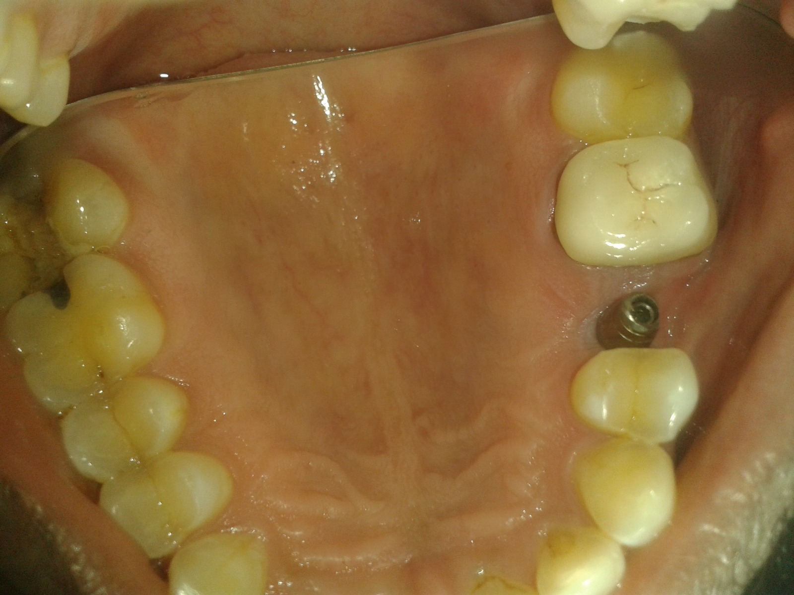 implants
