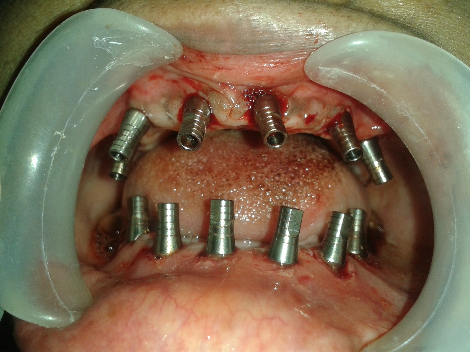 implants