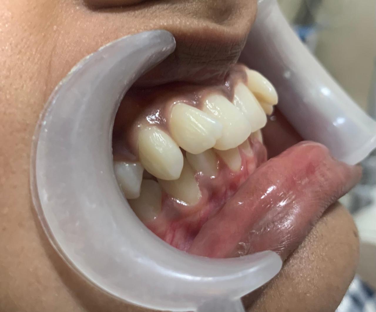 braces-after